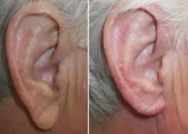 lobuloplastia