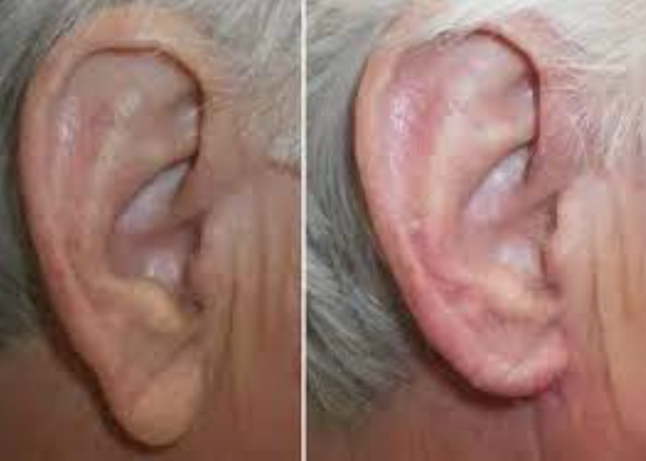 lobuloplastia