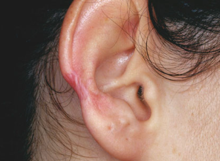quitar queloide