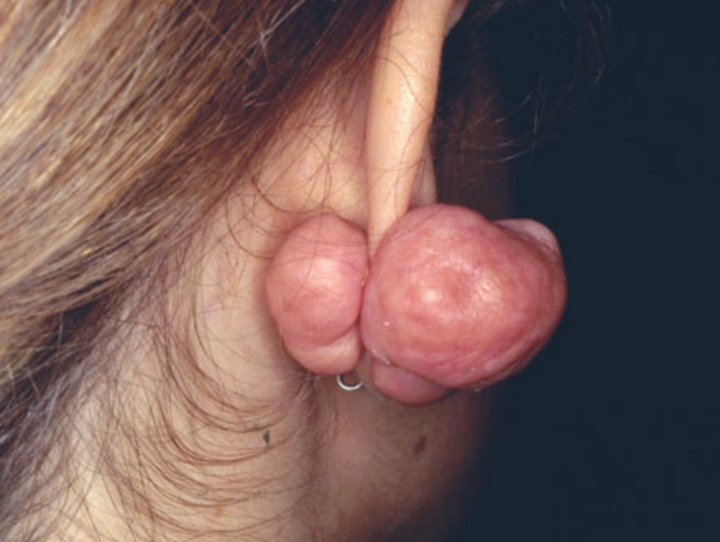 queloide