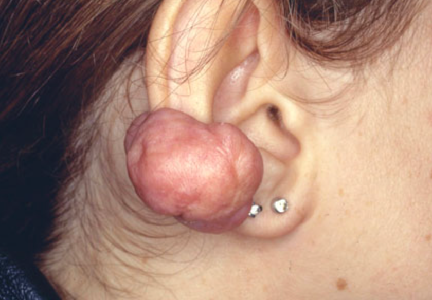 queloide
